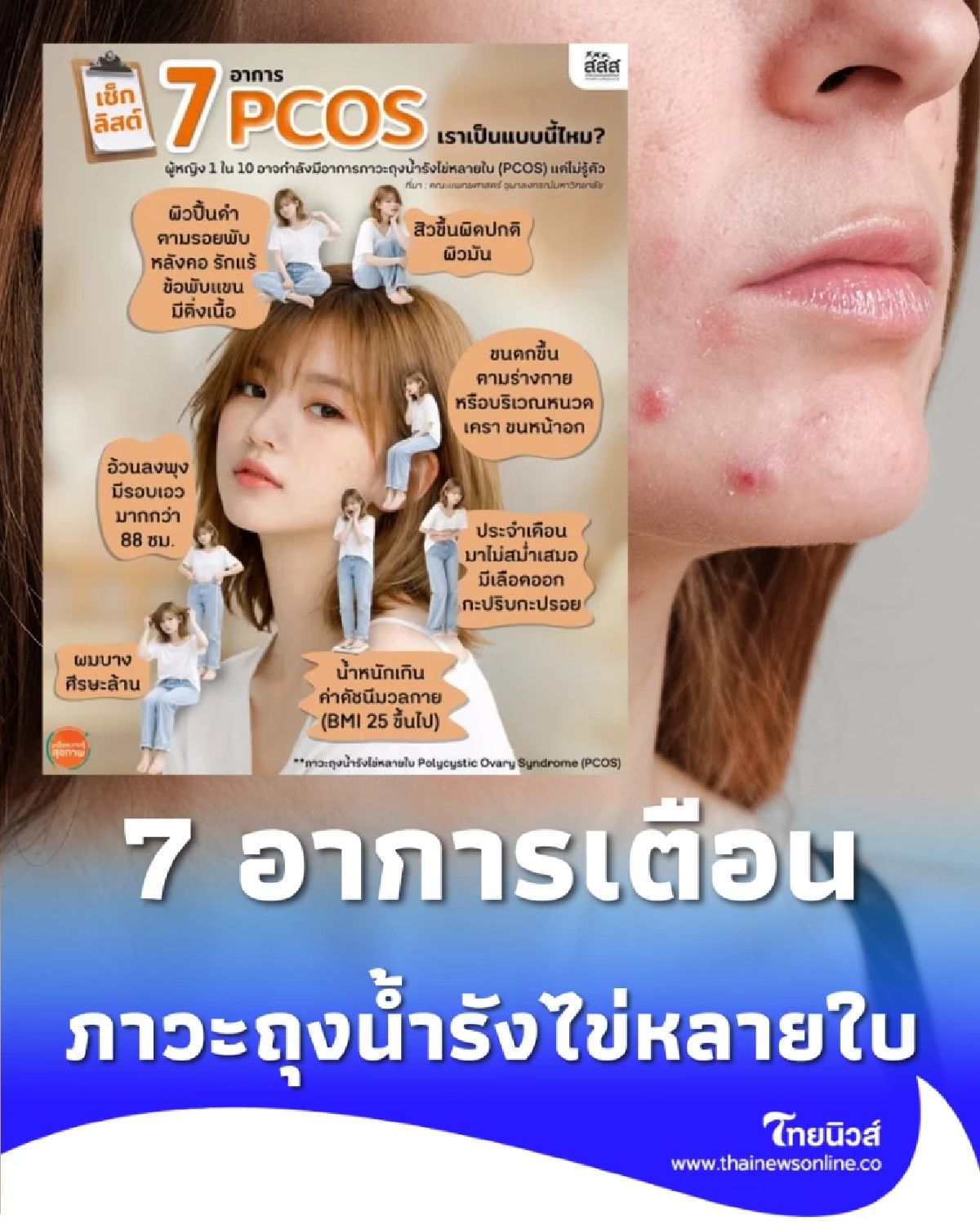 ผู้หญิงต้องรู้ 7 สัญญาณเตือน PCOS ภัยเงียบผู้หญิงที่ห้ามมองข้าม