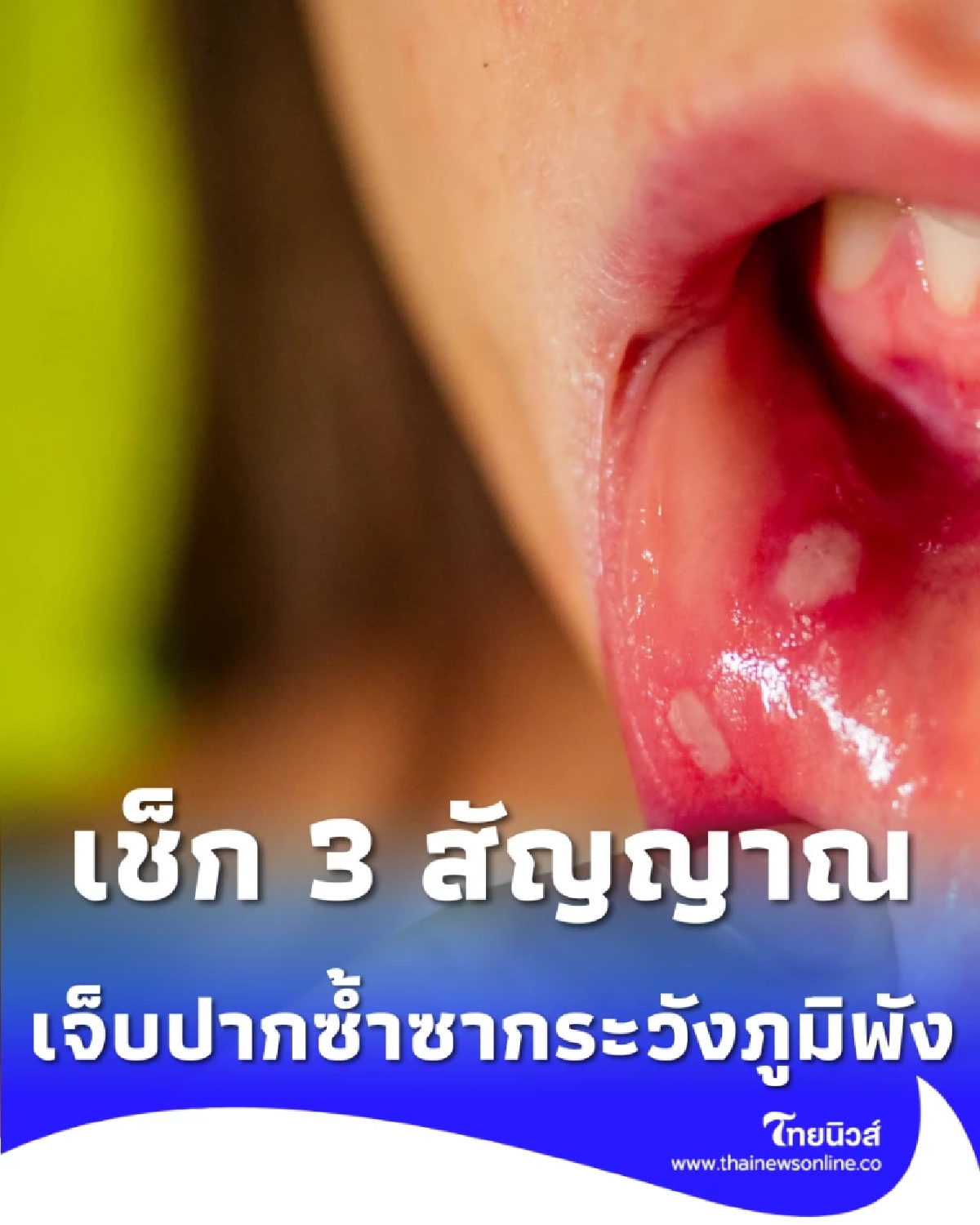 เจ็บปากซ้ำซากระวังภูมิพัง เช็ก 3 สัญญาณอันตรายและวิธีรักษาที่ต้นเหตุ