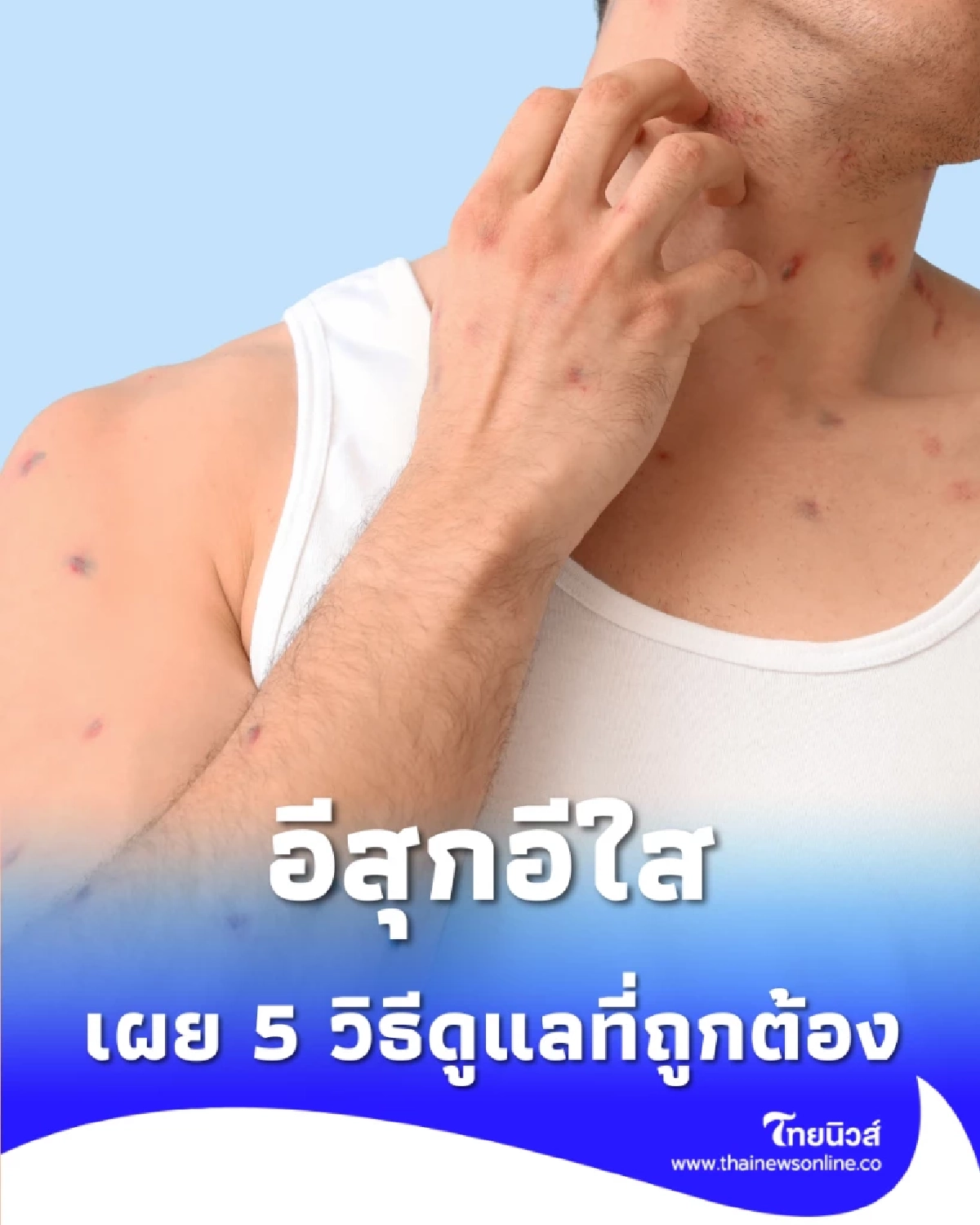 อีสุกอีใสระวังติดเชื้อรุนแรง เผย 5 วิธีดูแลที่ถูกวิธี ห้ามอาบน้ำต้มผัก