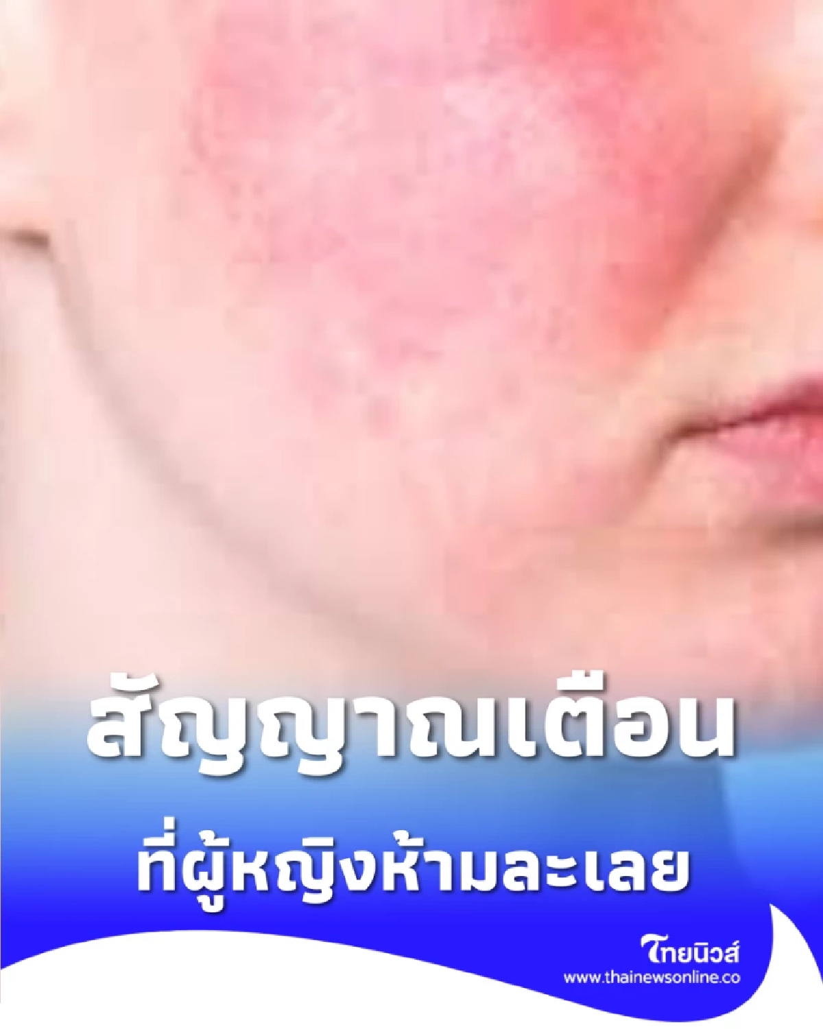 5 สัญญาณเตือน โรคแพ้ภูมิตัวเอง ที่ผู้หญิงห้ามละเลย ก่อนร่างกายพัง