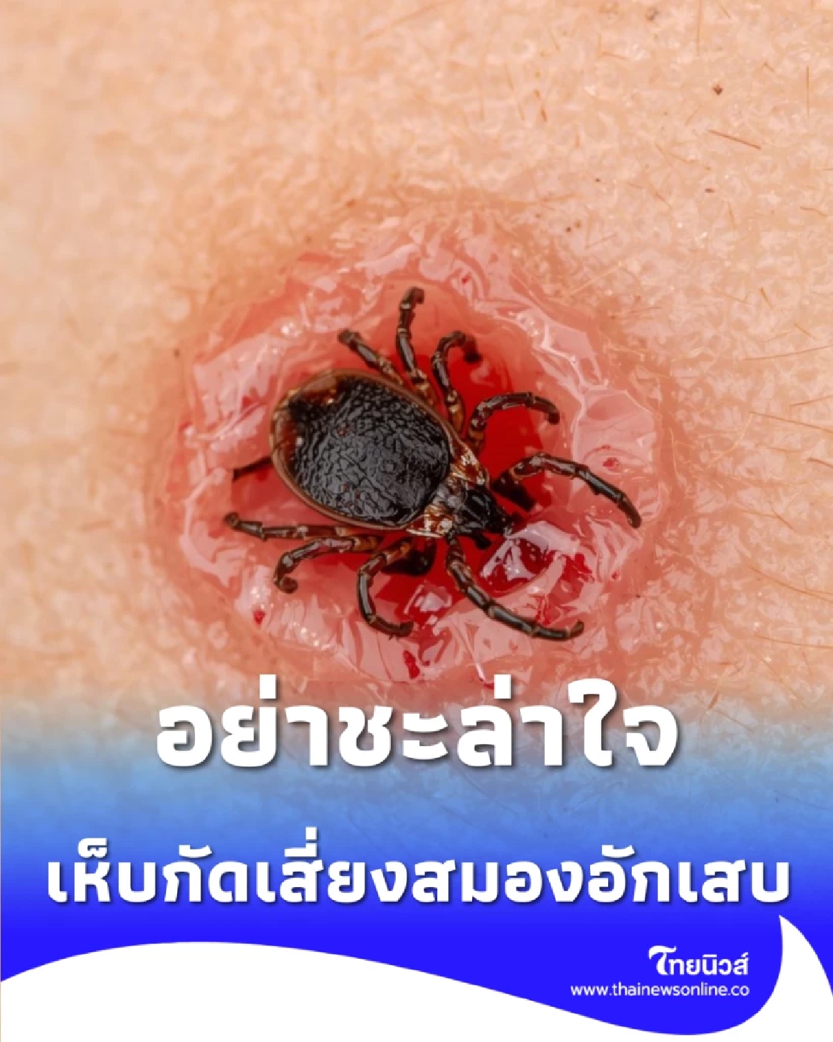 เช็ก ภัยใกล้ตัวจากเห็บกัด พบไวรัส SFTS ในไทย เสี่ยงสมองอักเสบ