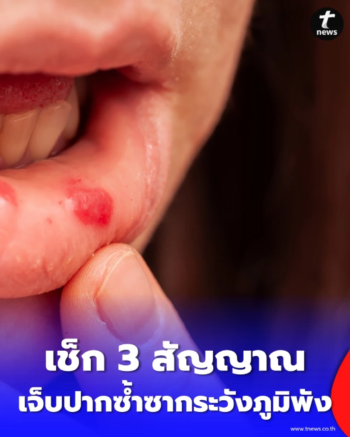 เจ็บปากซ้ำซากระวังภูมิพัง เช็ก 3 สัญญาณอันตรายและวิธีรักษาที่ต้นเหตุ