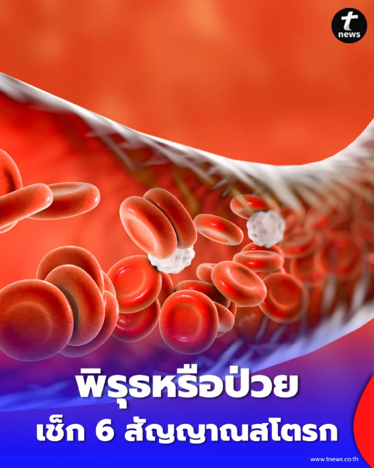 พิรุธหรือป่วย เช็ก 6 สัญญาณสโตรก BEFAST รู้ไวช่วยทัน