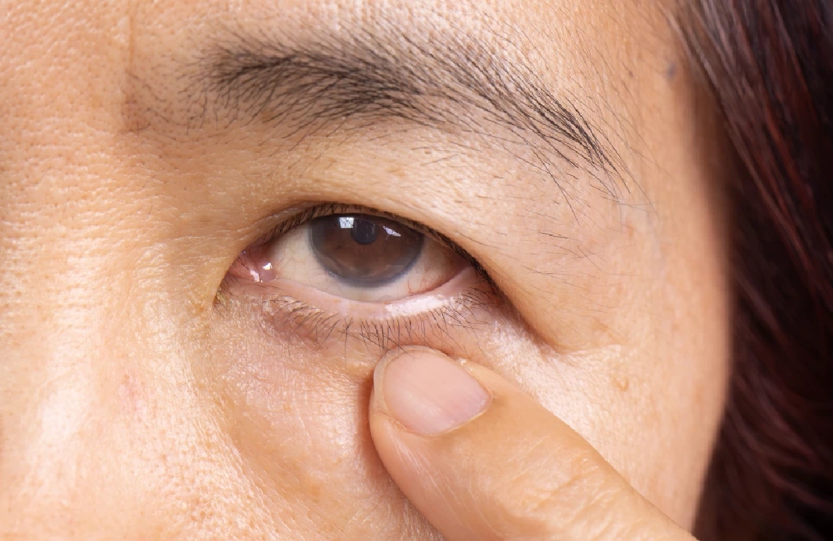 วิธีแก้ไขกล้ามเนื้อตาอ่อนแรง 2 แบบ