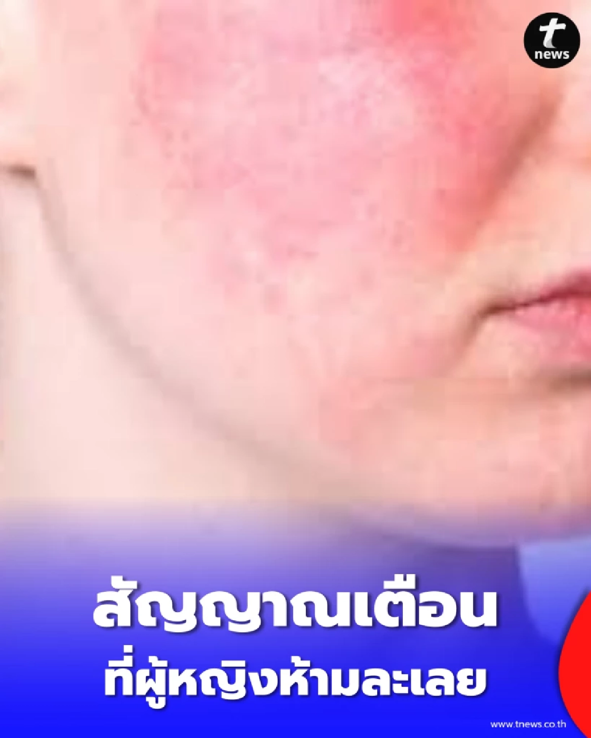 5 สัญญาณเตือน โรคแพ้ภูมิตัวเอง ที่ผู้หญิงห้ามละเลย ก่อนร่างกายพัง