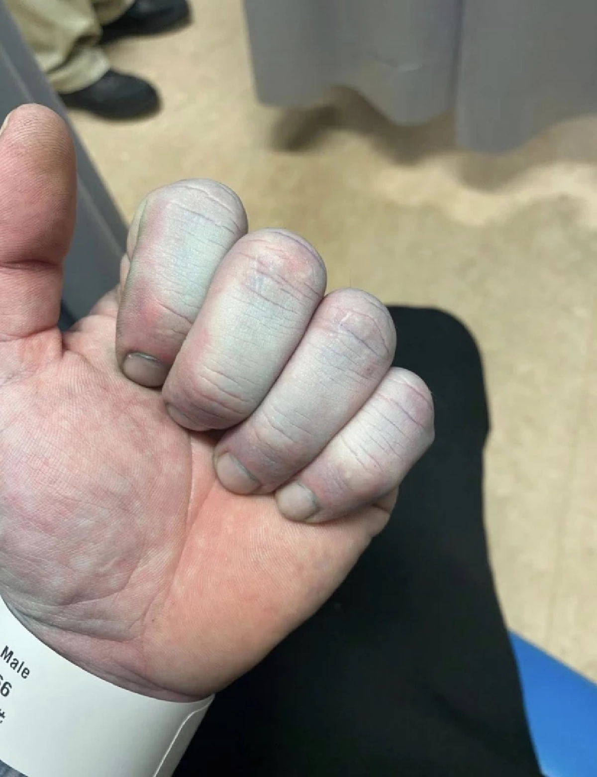 หนุ่มหลับยาว 14 ชม. ตื่นขึ้นตัวกลายเป็นสีฟ้า ผลตรวจออกมาทำตกใจ