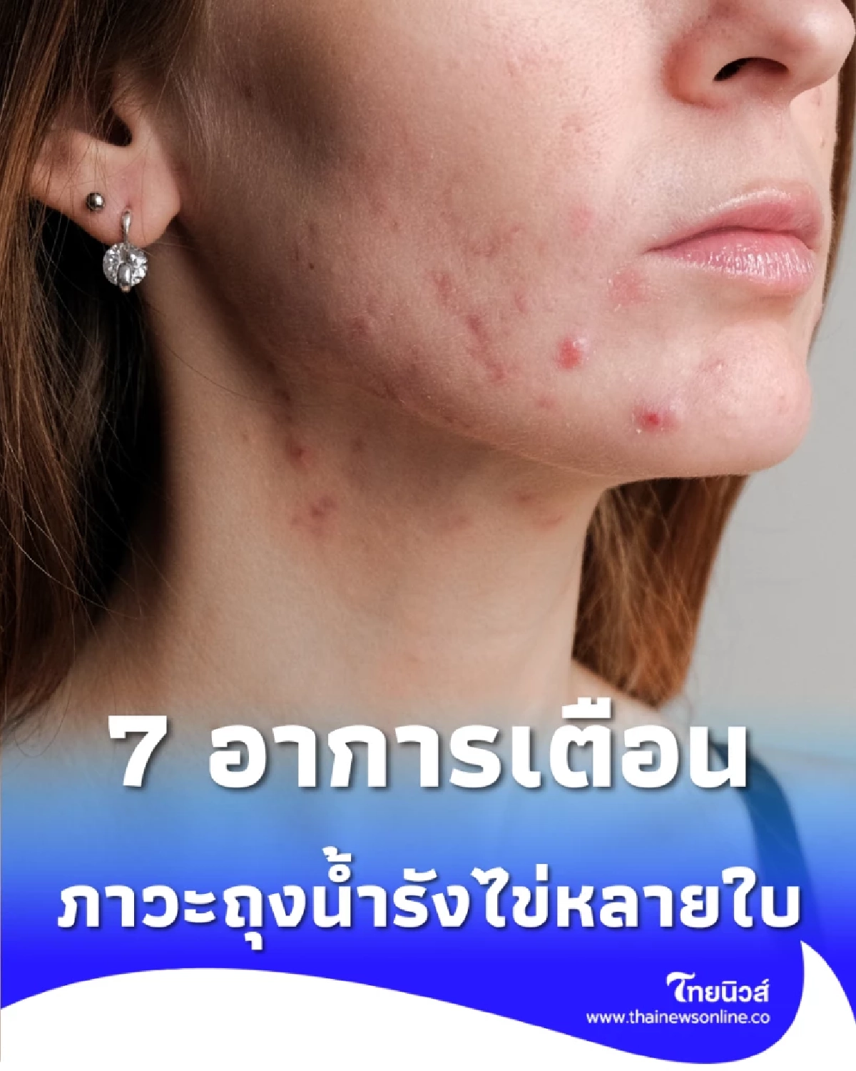 ผู้หญิงต้องรู้ 7 สัญญาณเตือน PCOS ภัยเงียบผู้หญิงที่ห้ามมองข้าม