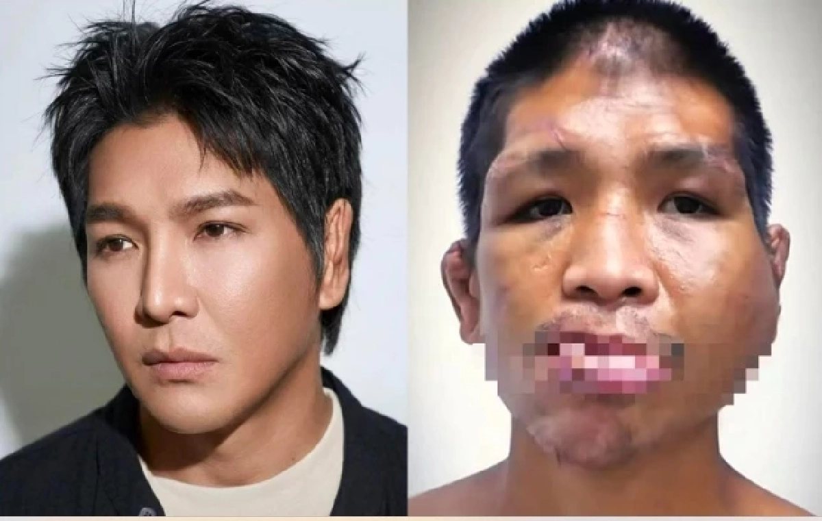 "หนุ่ม กรรชัย" โพสต์แล้ว น้องฟ้าได้ชีวิตใหม่ หลังผ่าตัด 11 ครั้ง