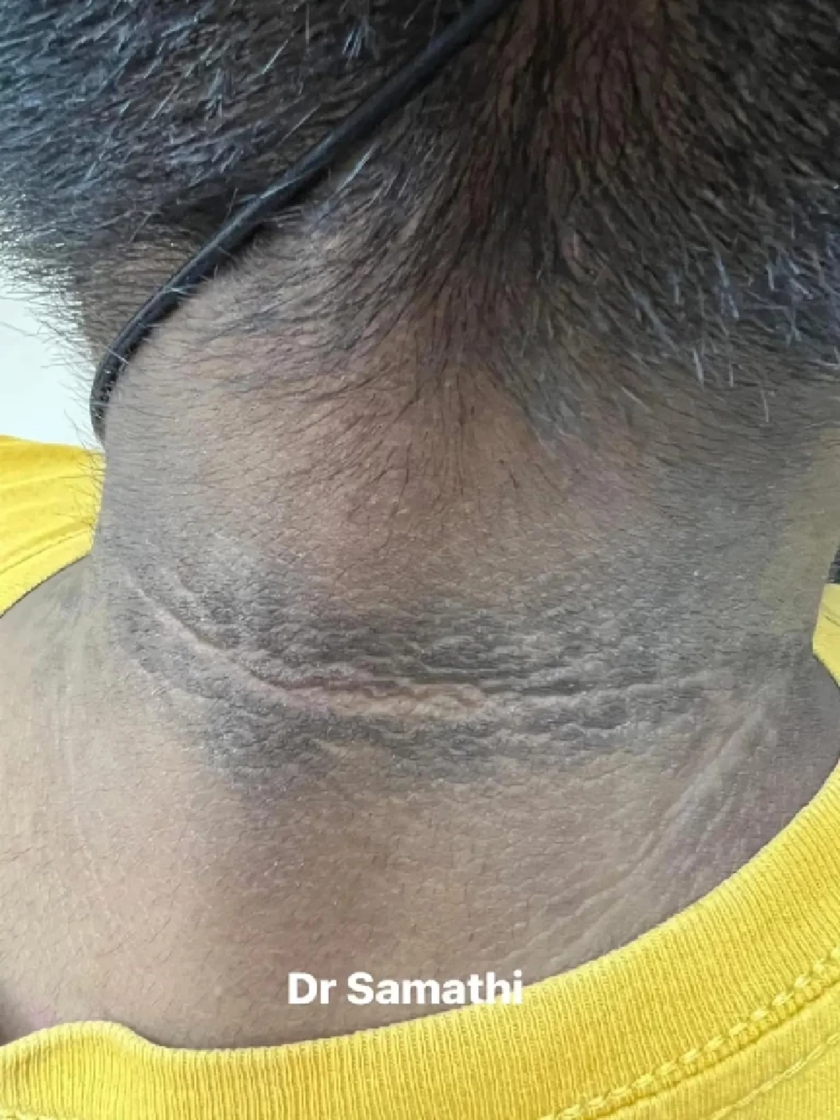 ถึงว่า "คอคาร์บอน" ขัดไม่ออก หมอเผยสัญญาณเสี่ยง ต้องแก้ให้ตรงจุด