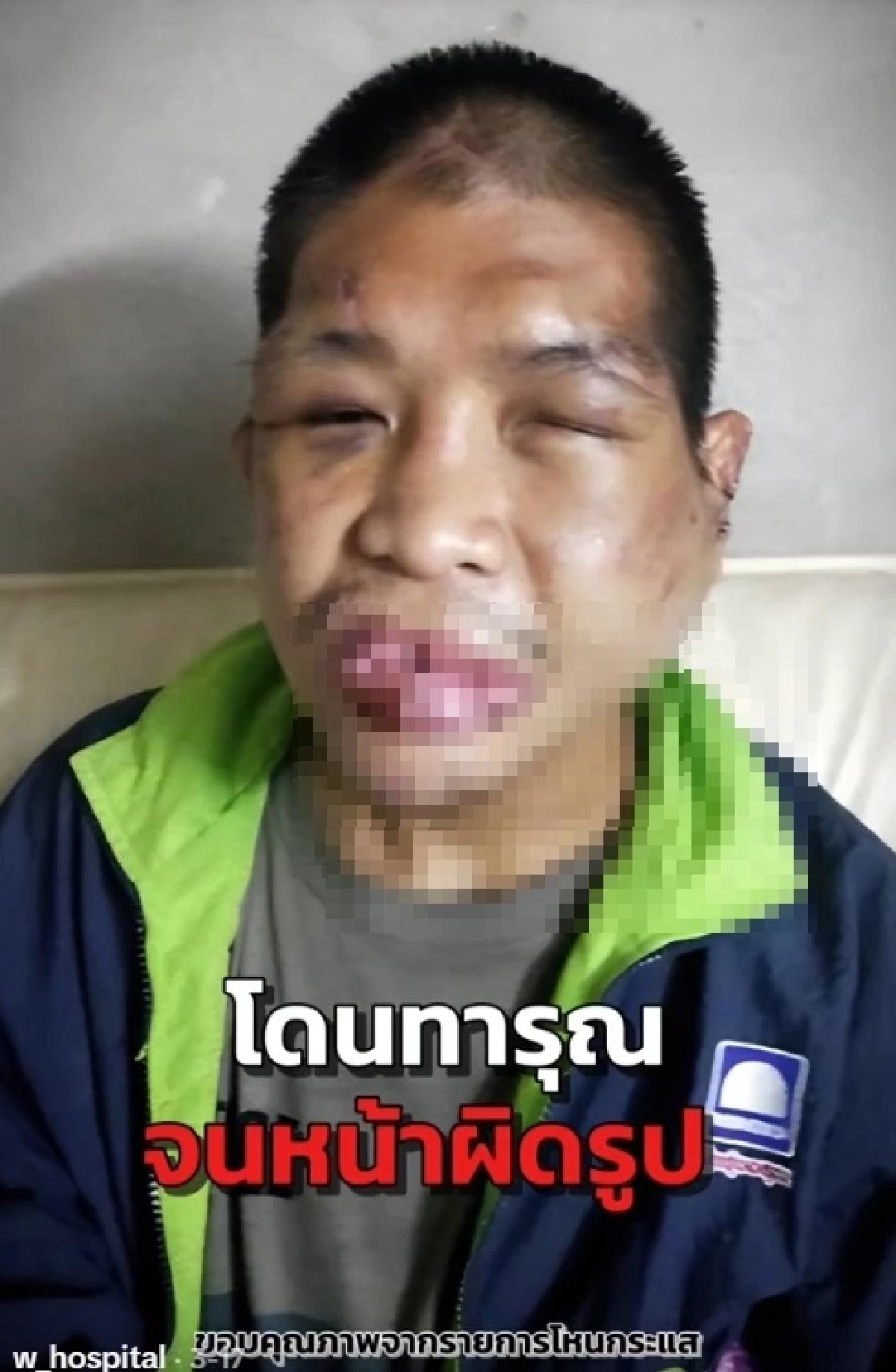 "หนุ่ม กรรชัย" โพสต์แล้ว น้องฟ้าได้ชีวิตใหม่ หลังผ่าตัด 11 ครั้ง