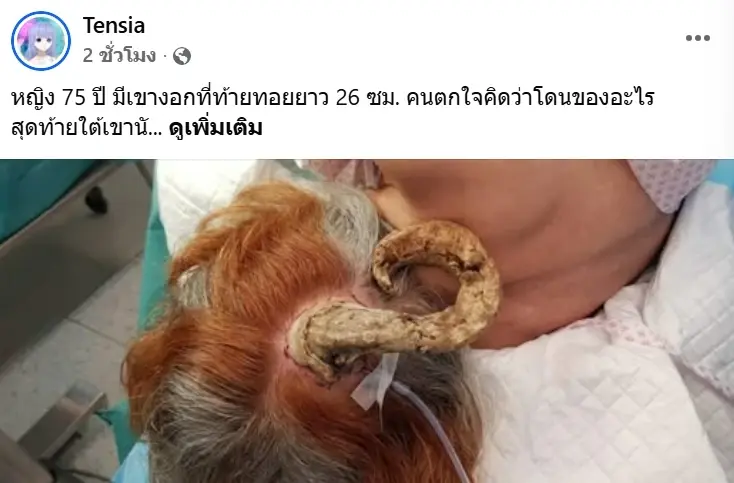 หญิงวัย 75 มี เขางอก คนรอบข้างเชื่อว่าโดนของ ก่อนรู้ผลตรวจจากหมอ