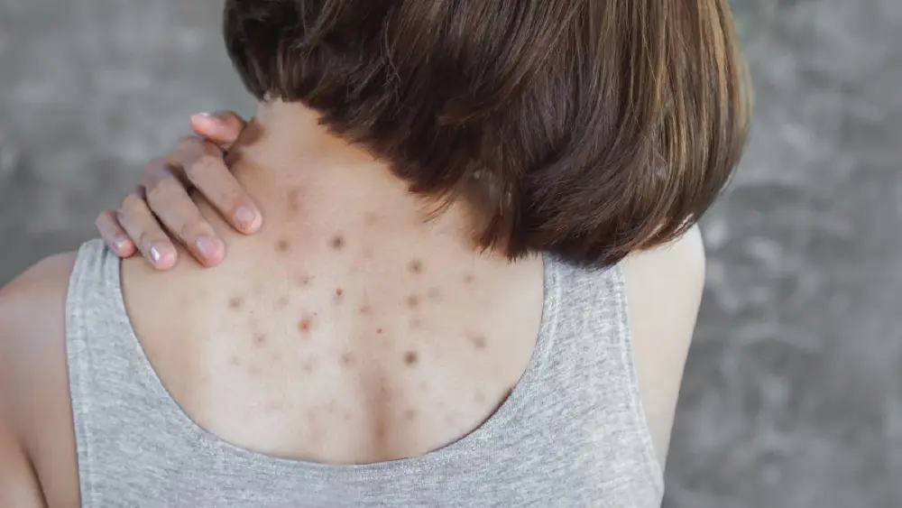 ผู้เชี่ยวชาญเผย สิวแต่ละจุดอาจกำลังเตือนปัญหาสุขภาพ