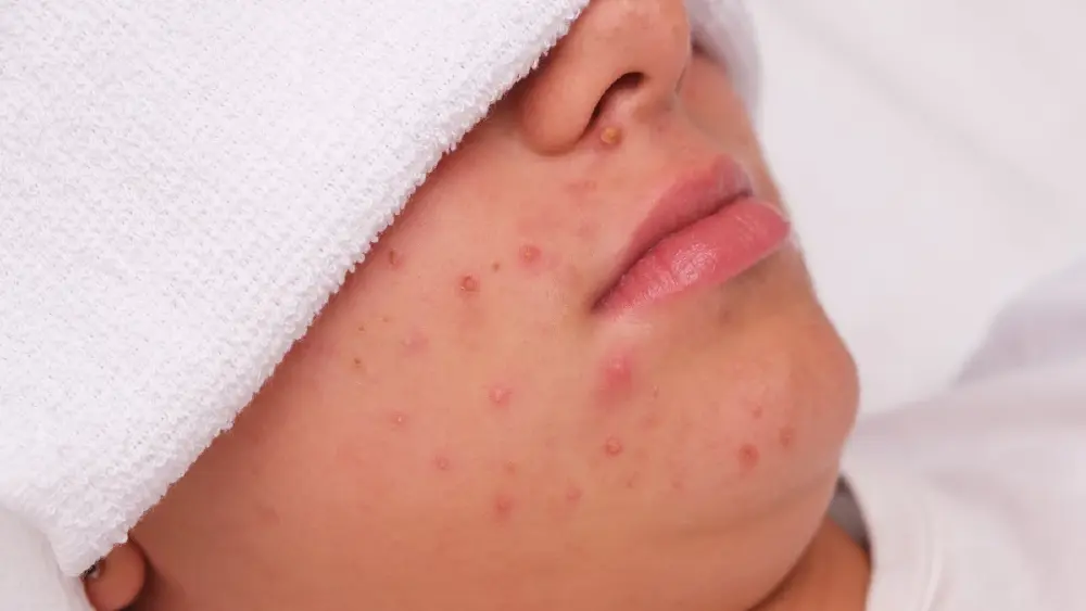 ผู้เชี่ยวชาญเผย สิวแต่ละจุดอาจกำลังเตือนปัญหาสุขภาพ