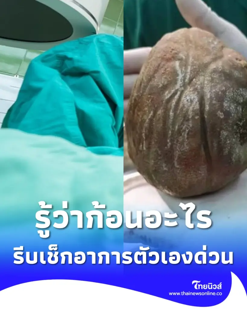 หมอยังตกใจ ผ่าก้อนปริศนาออกจากตัวคนไข้วัย 56 ก่อนรู้ว่าคืออะไร