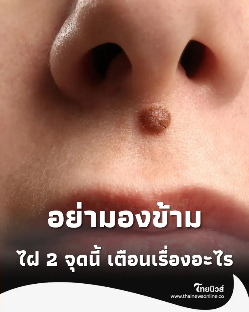 เปิดคำทำนาย ไฝที่คิ้ว-ใต้ตา จุดเปลี่ยนชีวิตที่หลายคนมองข้าม