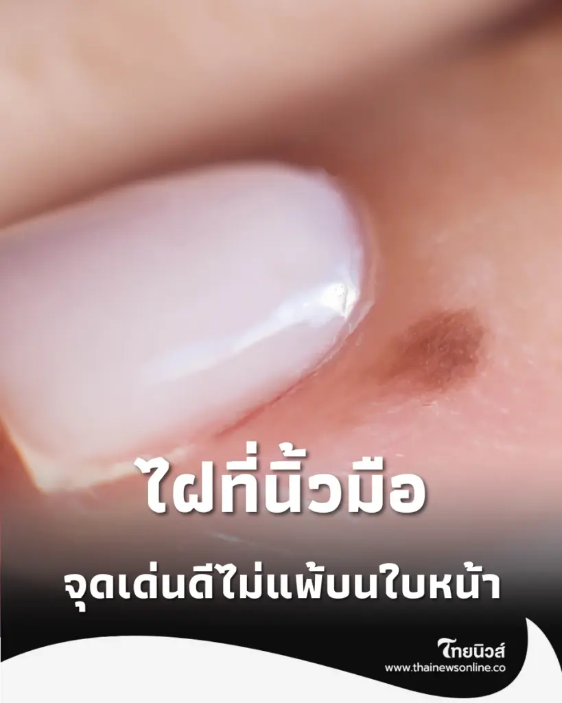 หมอช้างชี้ ไฝที่นิ้วมือ พลังแห่งการหาเงินที่คนส่วนใหญ่ไม่เคยรู้