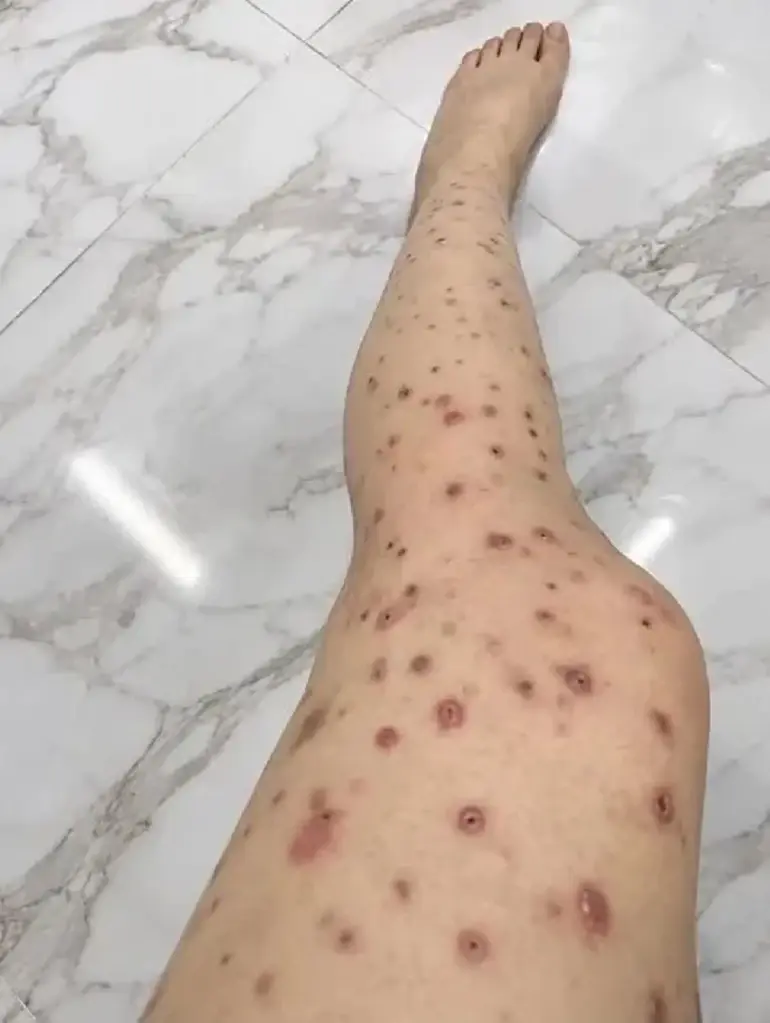 HIV ตรวจเองได้แล้ว เปิดวิธีเช็กเบื้องต้น ใครเสี่ยงเช็กด่วน