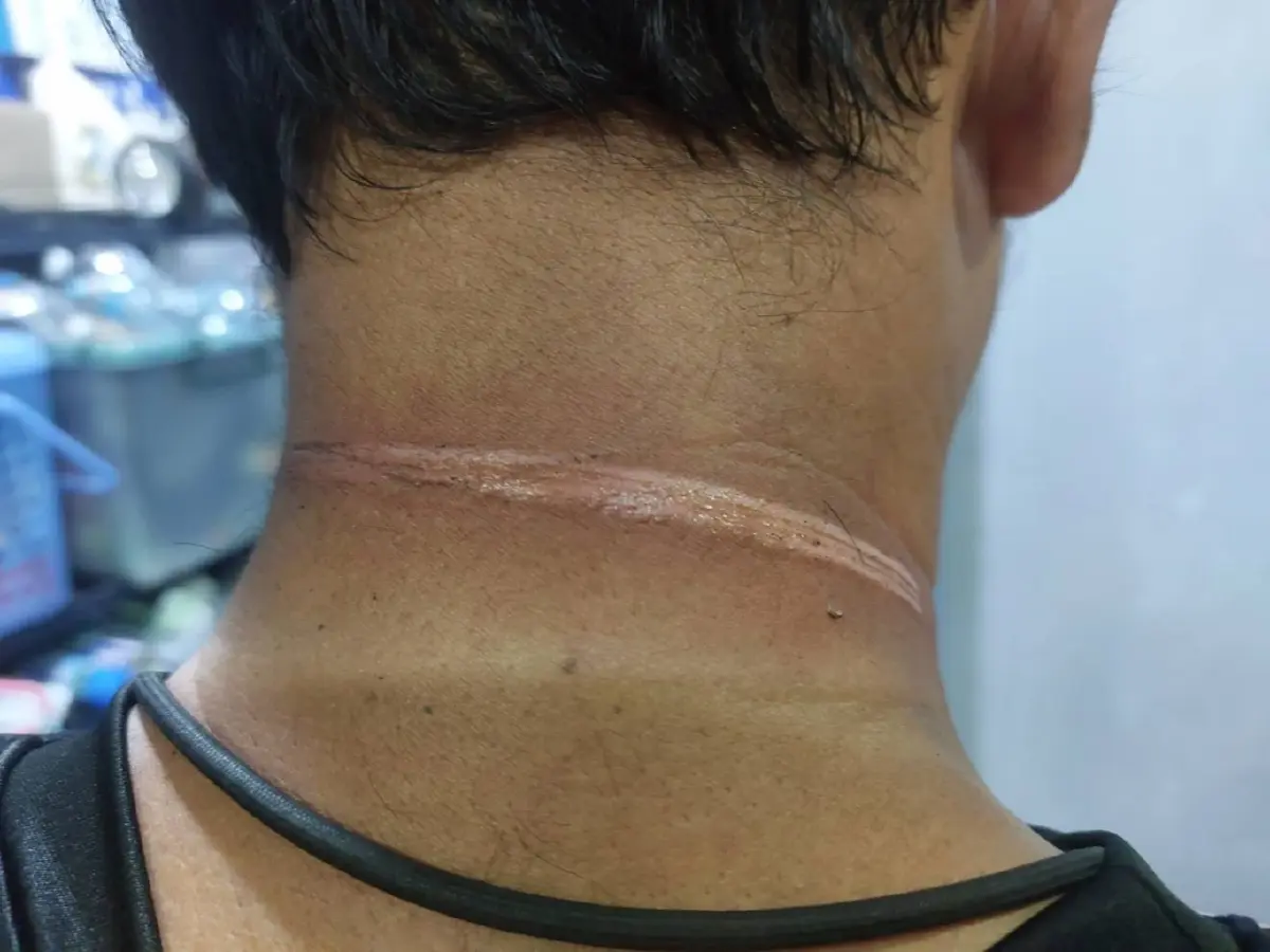รอยไหม้ยาวรอบคอ! ชายวัย 50 ขี่ จยย. โดนสายเคเบิลห้อยบาดคอเจ็บ