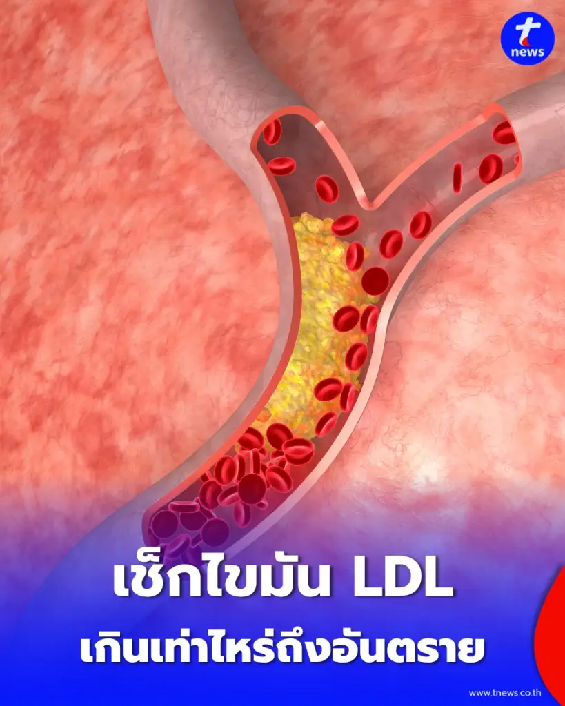 เช็กไขมันเลว LDL เกินเท่าไหร่ถึงอันตราย? เปิด 5 อาหารใกล้ตัวที่ควรเลี่ยง ป้องกันภัยเงียบทำลายหัวใจ