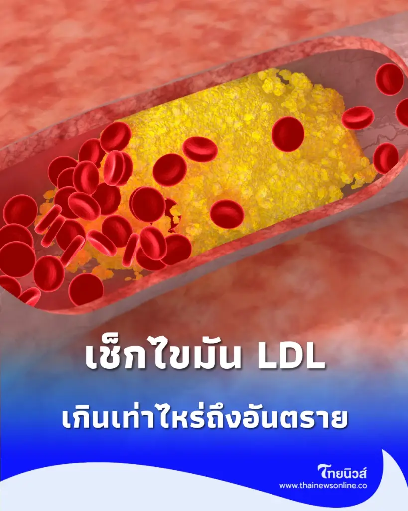 เช็กไขมันเลว LDL เกินเท่าไหร่ถึงอันตราย? เปิด 5 อาหารใกล้ตัวที่ควรเลี่ยง ป้องกันภัยเงียบทำลายหัวใจ