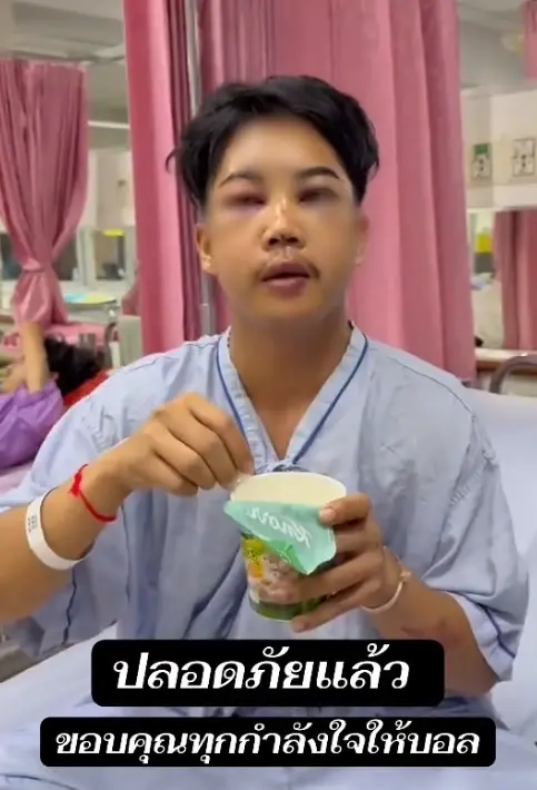 เห็นแล้วตกใจ "บอล โดเรม่อน" ใบหน้าล่าสุด หลังประสบอุบัติเหตุ