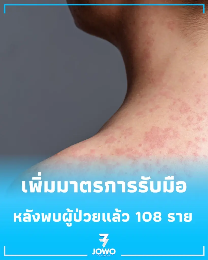 นิวยอร์กเพิ่มมาตรการคุม "โรคหัด" เข้มงวด หลังพบผู้ติดเชื้อสะสม 108 ราย