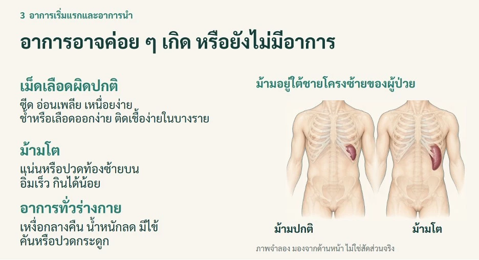 "เหนื่อยง่าย ซีด แน่นท้อง" อาการธรรมดาที่อาจไม่ธรรมดา รู้จักโรคพังผืดในไขกระดูก (MF)