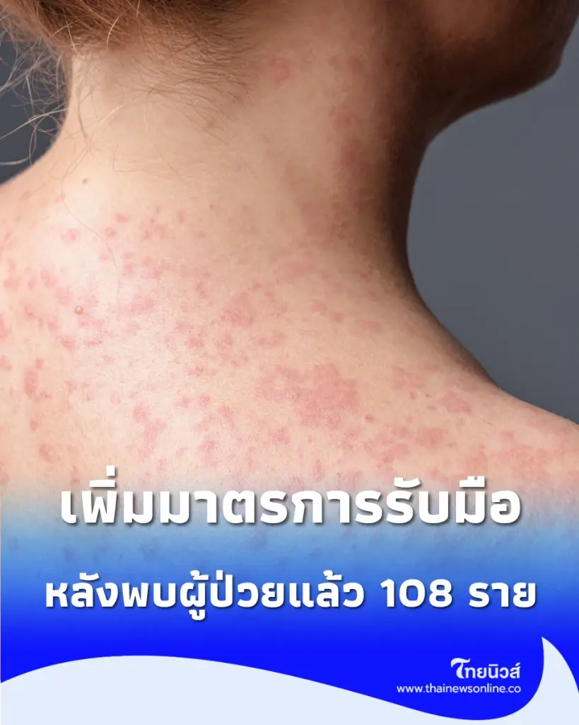 นิวยอร์กเพิ่มมาตรการคุม "โรคหัด" เข้มงวด หลังพบผู้ติดเชื้อสะสม 108 ราย