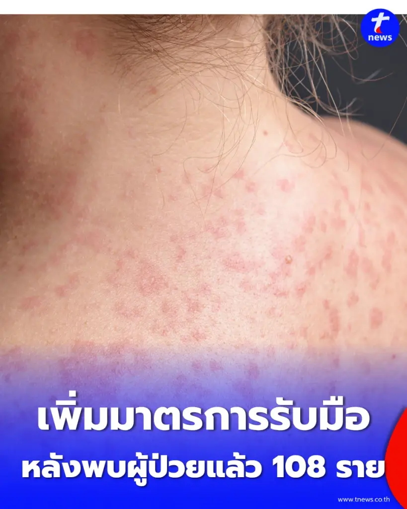 นิวยอร์กเพิ่มมาตรการคุม "โรคหัด" เข้มงวด หลังพบผู้ติดเชื้อสะสม 108 ราย