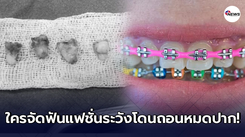 เตือนวัยรุ่นอยากเท่ห์ ดัดฟันแฟชั่นระวังไม่มีฟันไว้เคี้ยวข้าว เตือนวัยรุ่นอยากเท่ห์ ดัดฟันแฟชั่นระวังไม่มีฟันไว้เคี้ยวข้าว