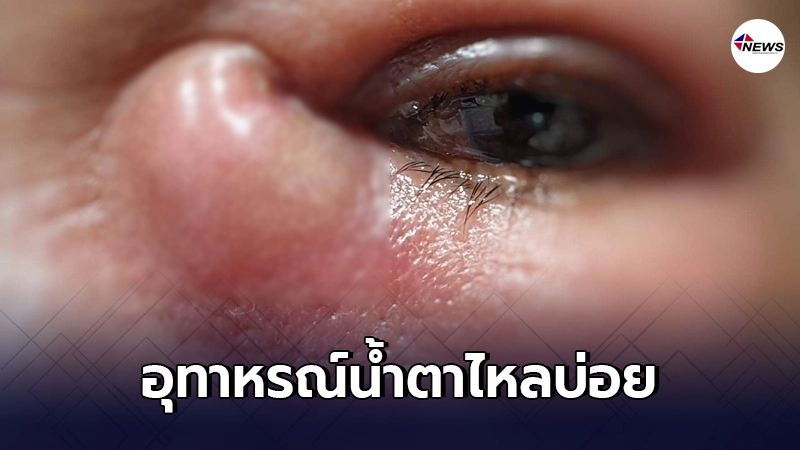 หญิงสาว "น้ำตาไหลบ่อย" แต่ยังมองเห็นชัดเจน แต่ไม่ยอมไปหาหมอ หญิงสาว "น้ำตาไหลบ่อย" แต่ยังมองเห็นชัดเจน แต่ไม่ยอมไปหาหมอ