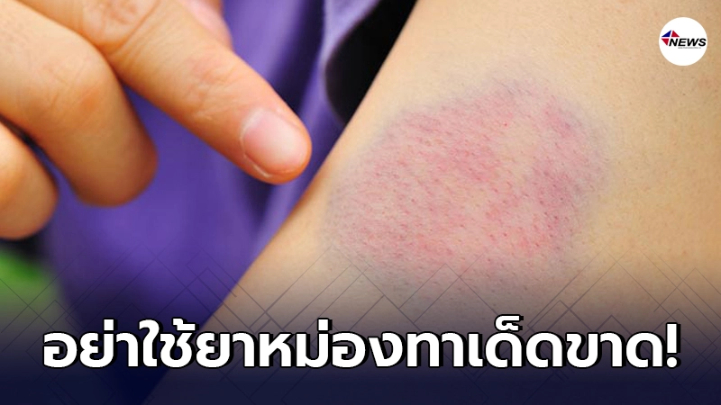 อย่าใช้"ยาหม่อง"ทารอยฟกช้ำเด็ดขาด มันจะไม่ดีขึ้นแถมแย่ลงอีกด้วย อย่าใช้"ยาหม่อง"ทารอยฟกช้ำเด็ดขาด มันจะไม่ดีขึ้นแถมแย่ลงอีกด้วย