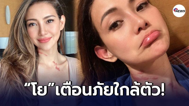 "โย ยศวดี" อัพเดทอาการ หลังโดนแมลงกัดที่คอ กลายเป็นรอยแดงขนาดใหญ่ "โย ยศวดี" อัพเดทอาการ หลังโดนแมลงกัดที่คอ กลายเป็นรอยแดงขนาดใหญ่