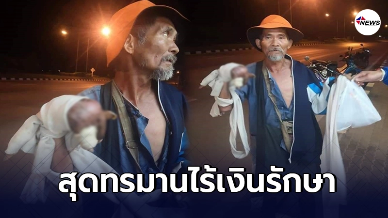 คุณลุงมือขวาใหญ่โตผิดปกติ สุดเจ็บป่วยทรมาน ไร้เงินรักษาร่างกาย