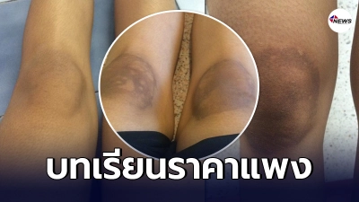 นักเรียนหญิงได้รับบทเรียนราคาแพง หลังลองใช้ยารักษาโรคผิวหนังตามรีวิว