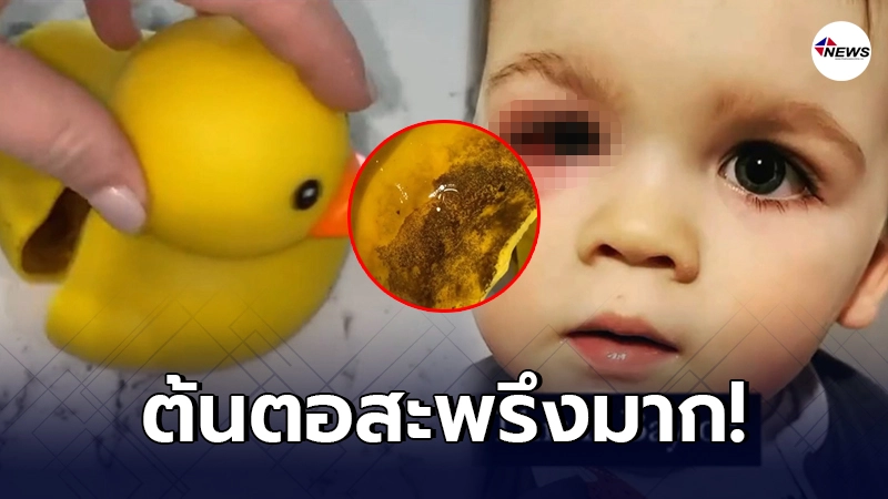 แม่ชาวต่างชาติ แทบขาดใจ ลูกชายติดเชื้อหลังอาบน้ำ ตาแดงเป็นสีเลือด แม่ชาวต่างชาติ แทบขาดใจ ลูกชายติดเชื้อหลังอาบน้ำ ตาแดงเป็นสีเลือด