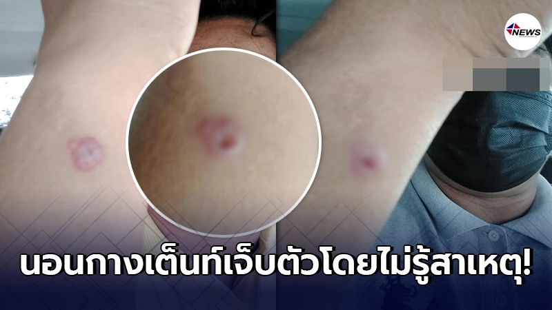 หนุ่มไปเที่ยว กางเต็นท์ ขากลับถึงขั้นสะดุ้งเฮือก ได้แผลมาไม่ทันรู้ตัว