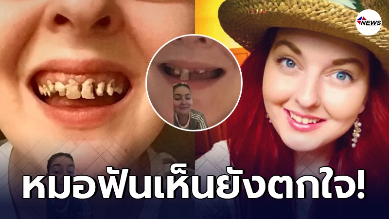 สาวอเมริกันฟันไม่ยอมแปรงกว่า10ปี ดื่มน้ำอัดลมแทนน้ำจนปากเหลือแต่เหงือก สาวอเมริกันฟันไม่ยอมแปรงกว่า10ปี ดื่มน้ำอัดลมแทนน้ำจนปากเหลือแต่เหงือก