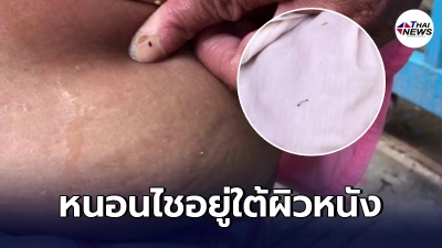 ป้าสุดทรมาน ตามตัวมีจุดดำๆ พอใกล้ความร้อนจะมีหนอนตัวเป็นๆไชออกมา