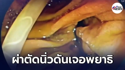 แพทย์ช็อก! หลังผ่าตัดนิ่วคนไข้เจอ พยาธิไส้เดือนในท้อง ตัวใหญ่ยาว แพทย์ช็อก! หลังผ่าตัดนิ่วคนไข้เจอ พยาธิไส้เดือนในท้อง ตัวใหญ่ยาว