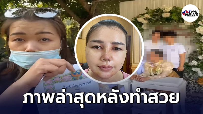 เปิดภาพล่าสุด เมียหลวงบุกงานแต่งในตำนาน หลังแปลงโฉมศัลยกรรม ครบ 5 วัน - ไทยนิวส์ออนไลน์ เปิดภาพล่าสุด เมียหลวงบุกงานแต่งในตำนาน หลังแปลงโฉมศัลยกรรม ครบ 5 วัน - ไทยนิวส์ออนไลน์