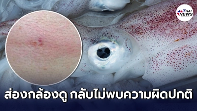 ชายญี่ปุ่นวัย 42 ปี กินปลาหมึกสดเพิ่งจับมาใหม่ๆ ผ่านไป 9 วัน มีอาการผิดสำแดง ชายญี่ปุ่นวัย 42 ปี กินปลาหมึกสดเพิ่งจับมาใหม่ๆ ผ่านไป 9 วัน มีอาการผิดสำแดง
