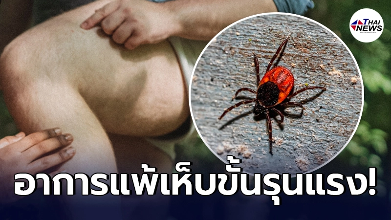 เผยอาการหลังโดน "เห็บ" กัด บางคนแพ้รุนแรง ส่งผลไปถึงระบบหายใจ - ไทยนิวส์ออนไลน์ เผยอาการหลังโดน "เห็บ" กัด บางคนแพ้รุนแรง ส่งผลไปถึงระบบหายใจ - ไทยนิวส์ออนไลน์