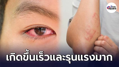 เผยวิธีสังเกต อาการล่าสุดของโควิด หากมีผื่น-ตาแดง แบบนี้ รีบไปหาหมอทันที เผยวิธีสังเกต อาการล่าสุดของโควิด หากมีผื่น-ตาแดง แบบนี้ รีบไปหาหมอทันที