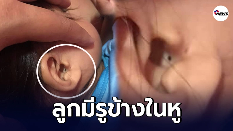 แม่สุดห่วง ลูกมีรูข้างในหู พอโดนน้ำจะคันและมีกลิ่นเหม็น อันตรายไหม -ไทยนิวส์ออนไลน์ แม่สุดห่วง ลูกมีรูข้างในหู พอโดนน้ำจะคันและมีกลิ่นเหม็น อันตรายไหม -ไทยนิวส์ออนไลน์