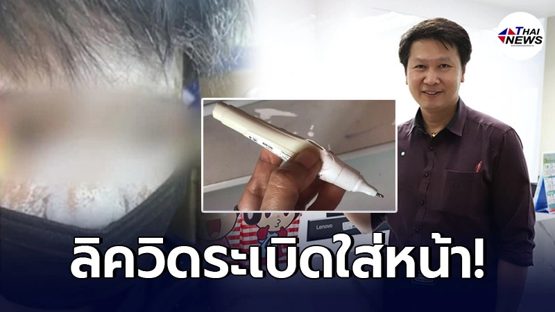 แม่ตกใจ ลูกชายถูกลิควิดระเบิดใส่หน้าขาวโพลน อ.เจษฎา แจงสาเหตุหลักทำบึ้ม แม่ตกใจ ลูกชายถูกลิควิดระเบิดใส่หน้าขาวโพลน อ.เจษฎา แจงสาเหตุหลักทำบึ้ม