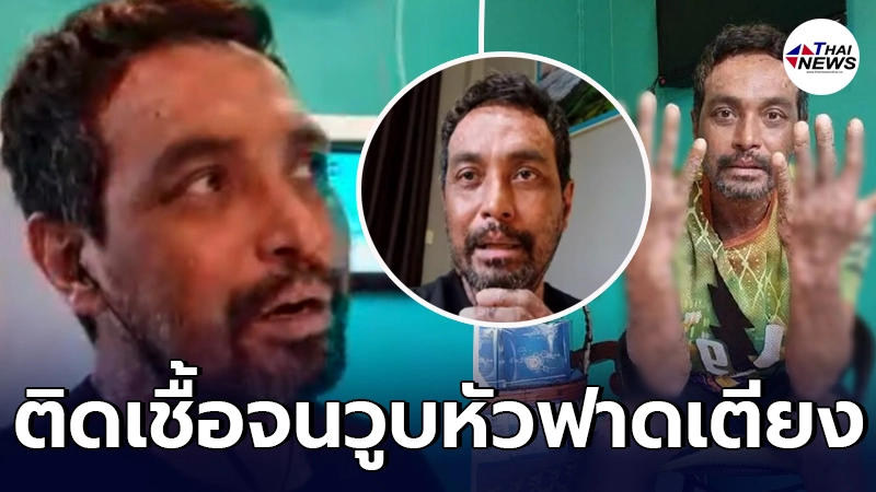เมฆ วินัย เผยวูบหัวฟาดเตียง หลังติดเชื้อที่ผิวหนัง โชคดีภรรยาพาส่ง รพ.ทัน