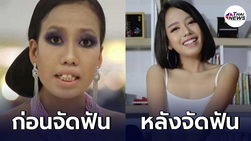 "ตุ๊ก เดอะว้าวลาว" หลังจัดฟัน สวยขึ้นกว่าเดิม เปลี่ยนไปอย่างกับคนละคน "ตุ๊ก เดอะว้าวลาว" หลังจัดฟัน สวยขึ้นกว่าเดิม เปลี่ยนไปอย่างกับคนละคน