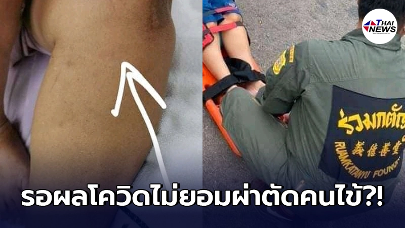 หลานร้องทุกข์ ป้ารถล้มเจ็บหนักต้องผ่าตัดขา แต่หมอรพ.ดังขอรอผลตรวจโควิด หลานร้องทุกข์ ป้ารถล้มเจ็บหนักต้องผ่าตัดขา แต่หมอรพ.ดังขอรอผลตรวจโควิด