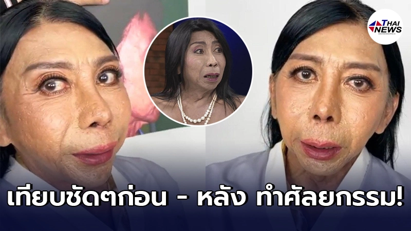 สิตางศุ์ บัวทอง เทียบภาพให้ดูชัดๆ ก่อน - หลัง ทำศัลยกรรมด้วยงบกว่า 4 ล้าน